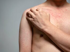Rashes caused due to Measles | Credits: Getty Images