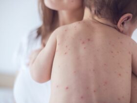Representation for rashes caused by measles infection | Credits: Getty Images